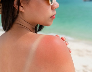 9 Remedies That Take the Sting Out of a Sunburn